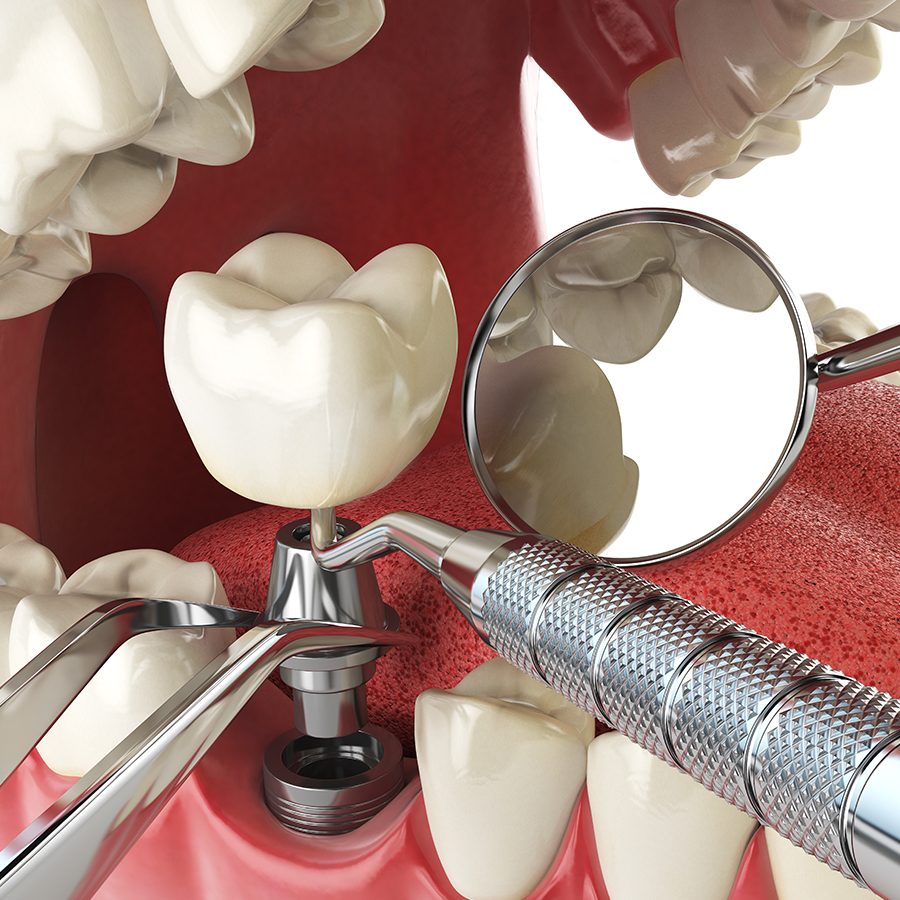 Dental Implants