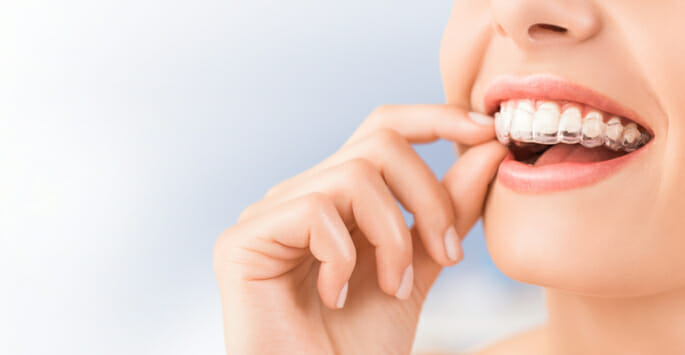 clear braces - Sneed Dental Arts